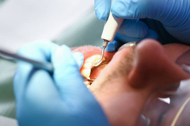 Best Emergency Tooth Extraction in Yadkinville, NC