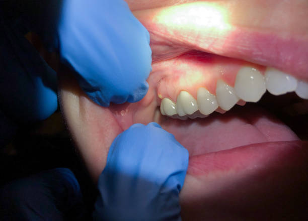 Best Emergency Treatment for Toothache in Yadkinville, NC